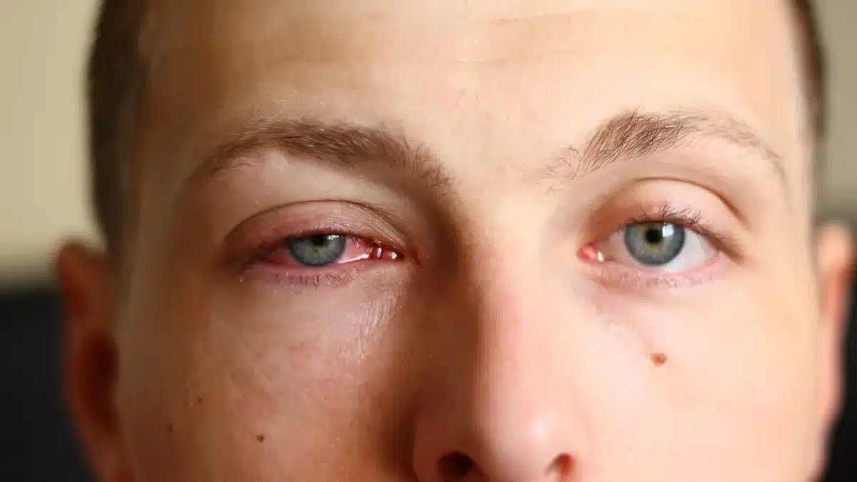 pink eye
