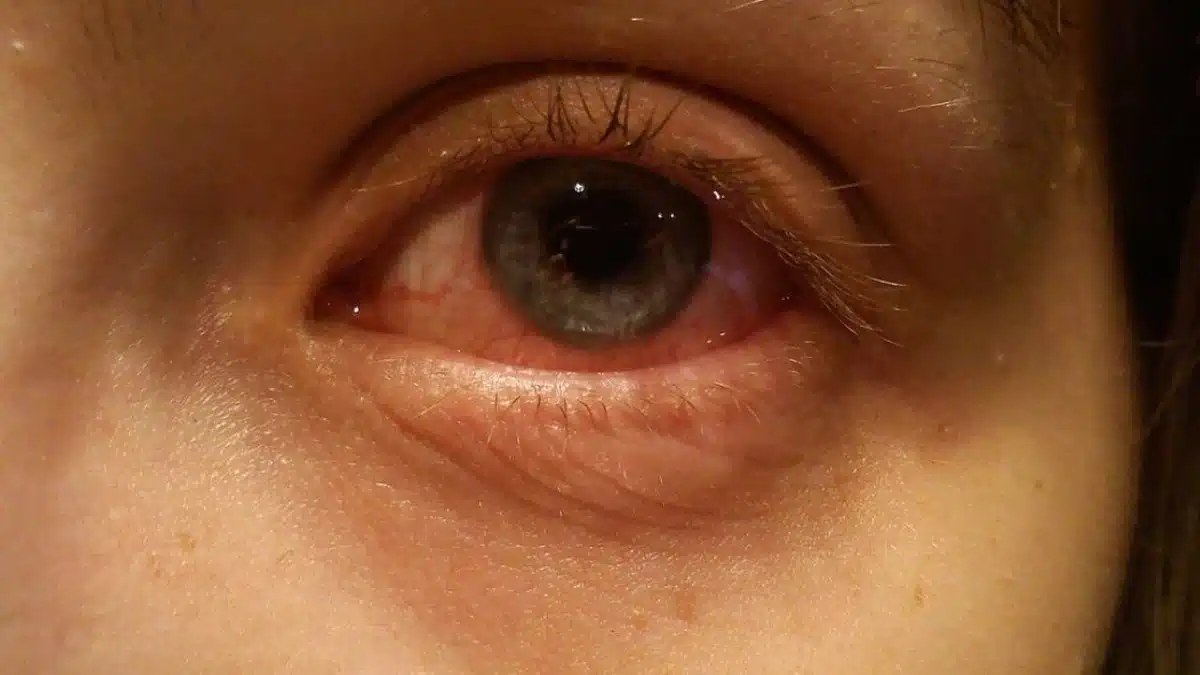 Pink eye of a woman