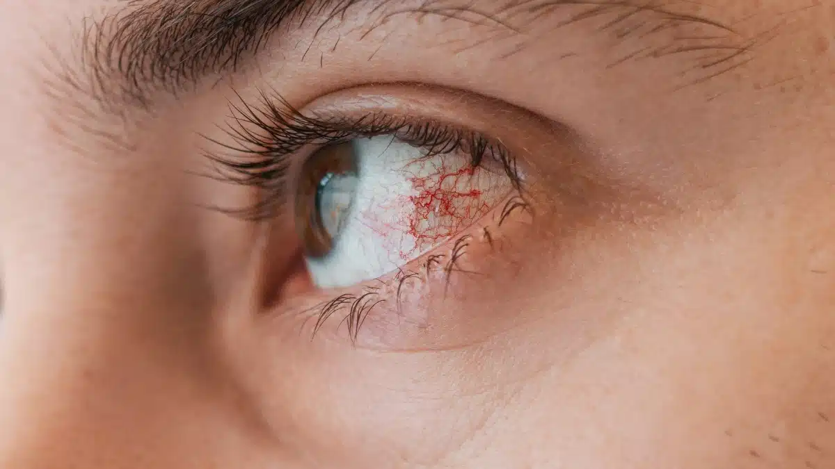 posterior uveitis