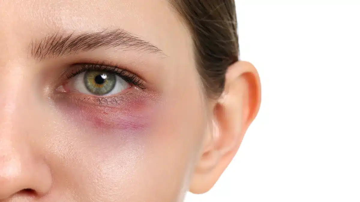 Red Bumps Under The Eyes: Causes and Effective Treatments