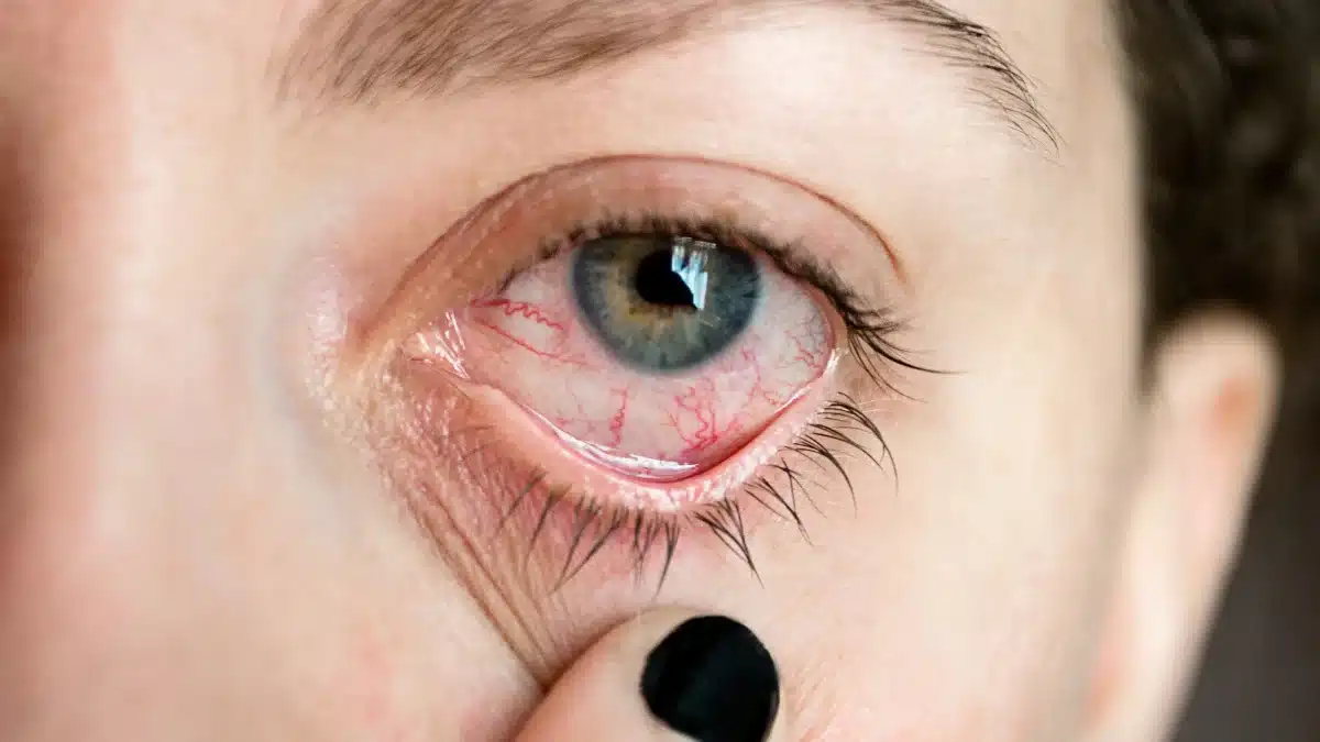 red itchy eyes
