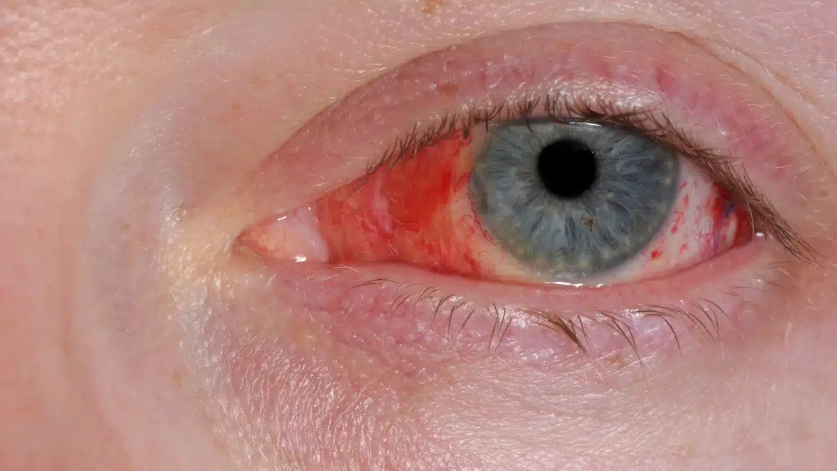 red spot on the eye