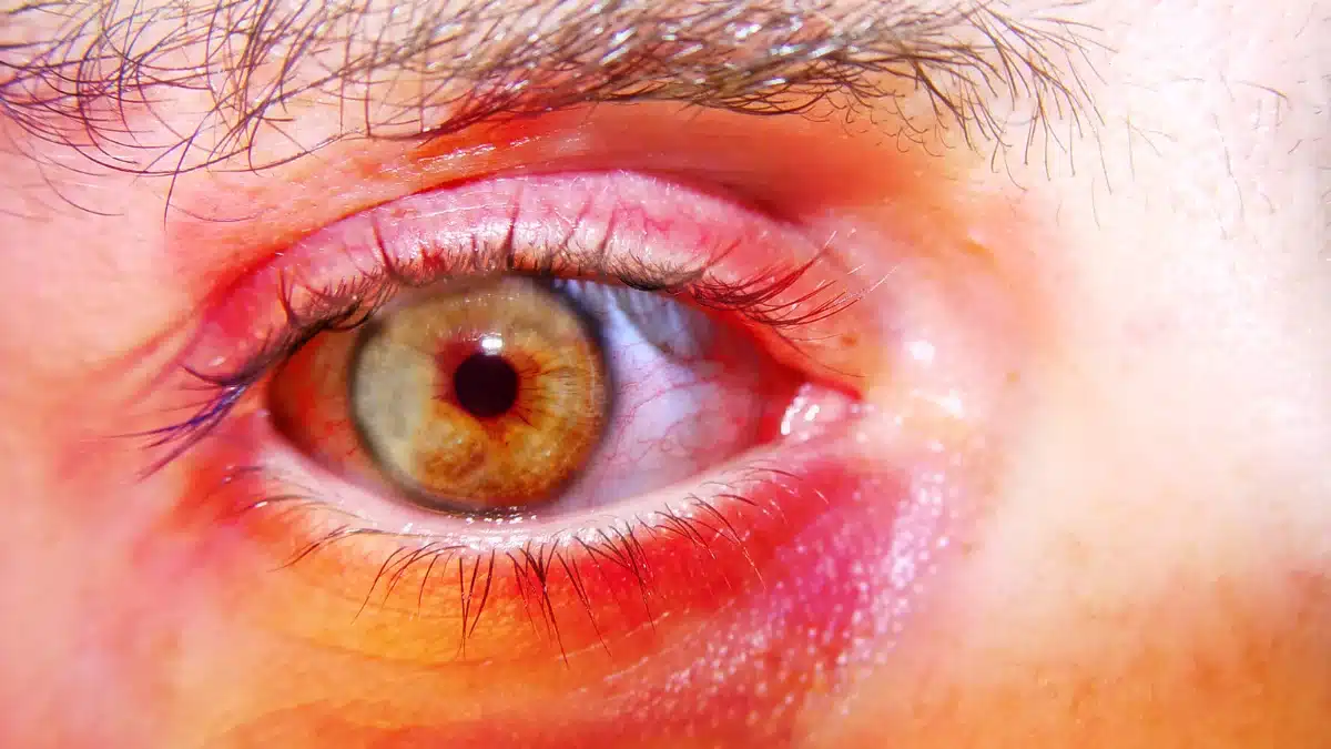 redness around the eyes