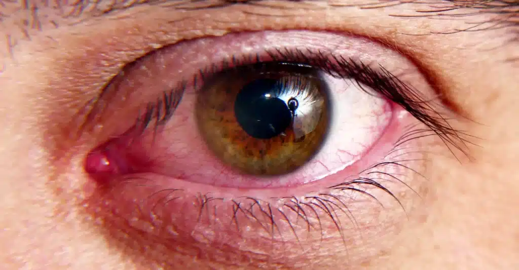 Symptoms of Corneal Ulcer
