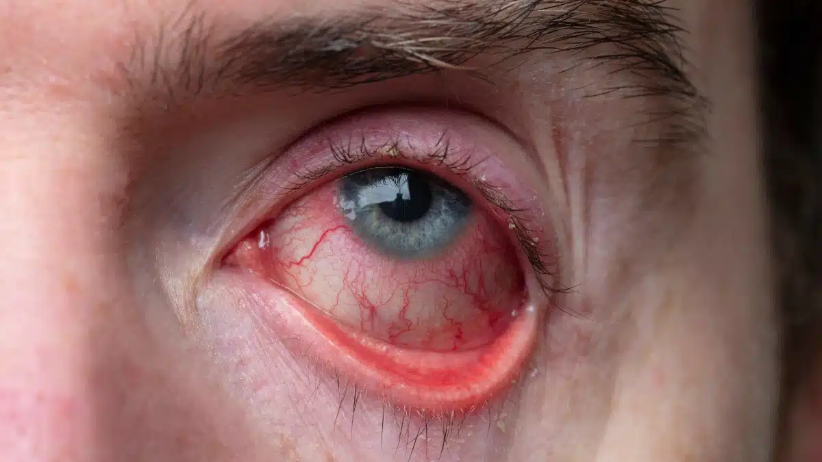 uveitis medication