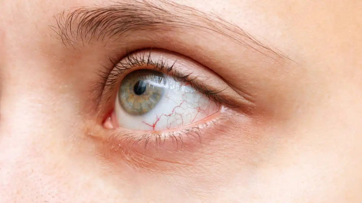 uveitis treatment