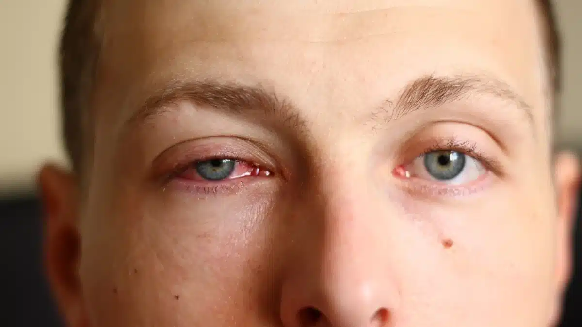 when is pink eye not contagious