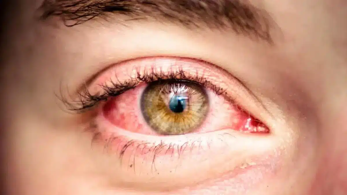 what causes eye floaters