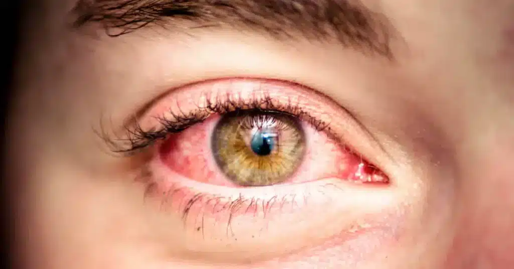 red eyes