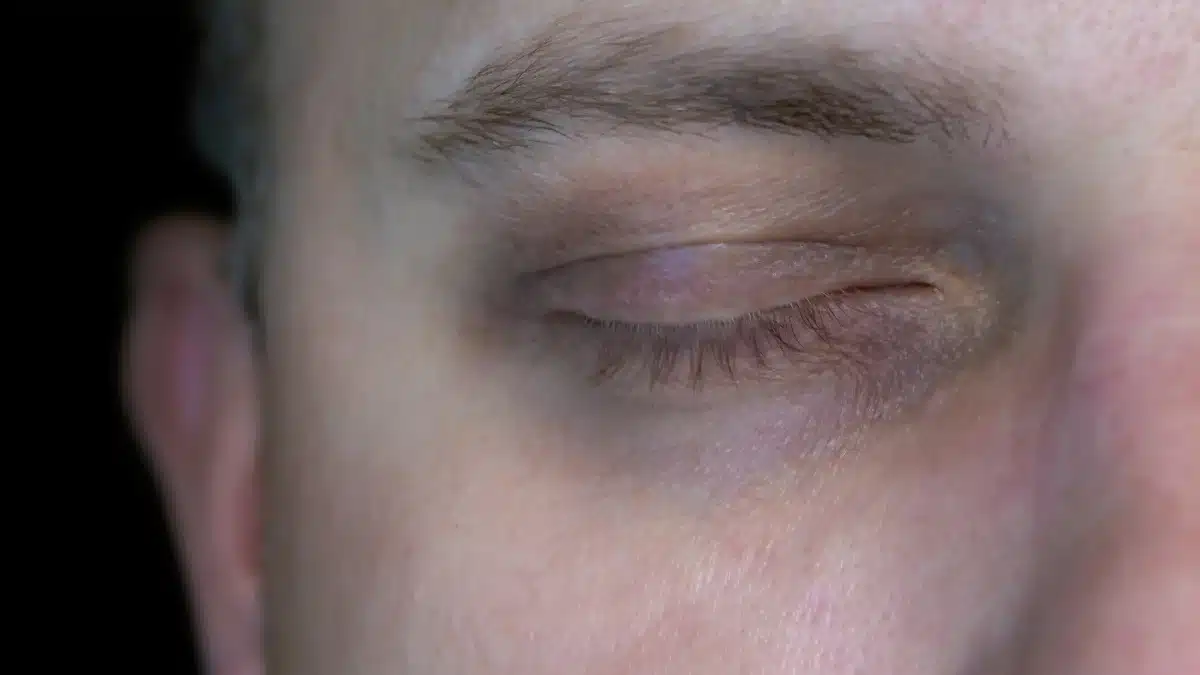 home remedies for bags under eyes