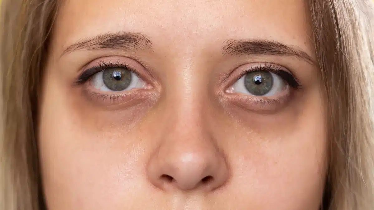bags under eyes treatment