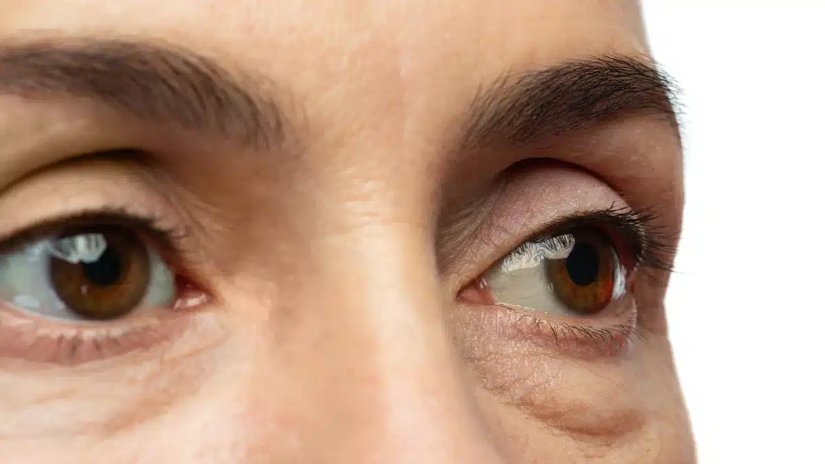 dehydration cause eye floaters
