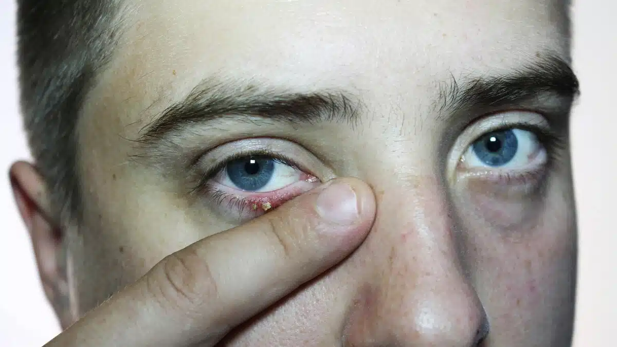 discharge from eye allergies