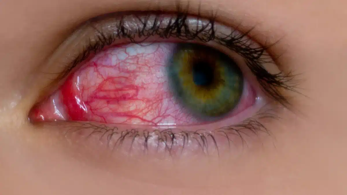 eye allergy treatment