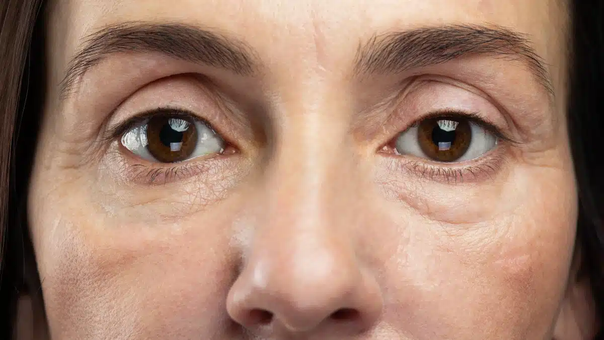 hypothyroidism puffy eyes