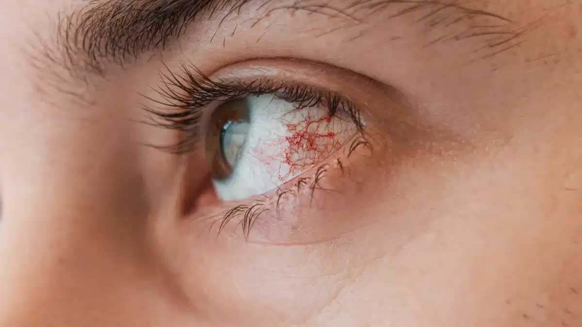 keratitis