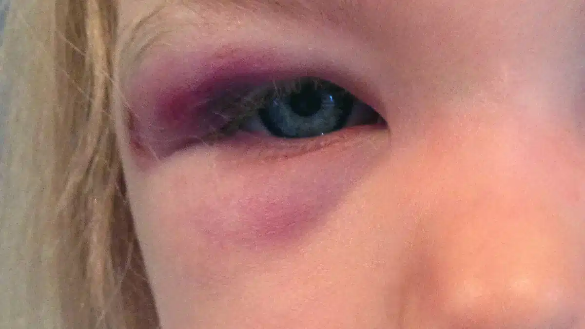 medication for swollen eye