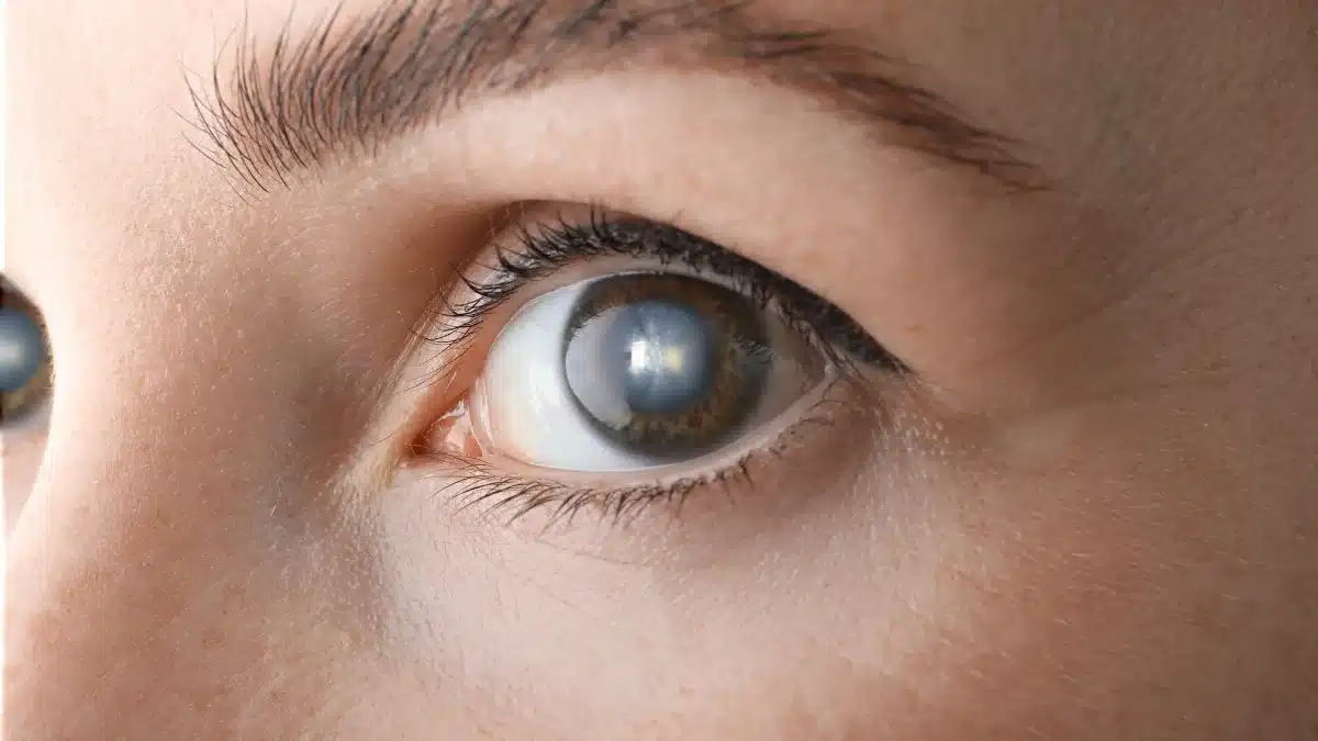 posterior polar cataract