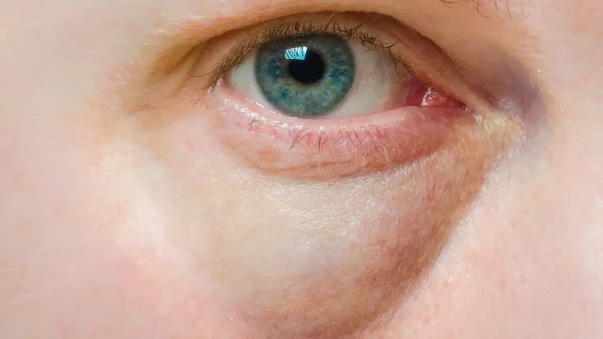 puffy eyes remedy