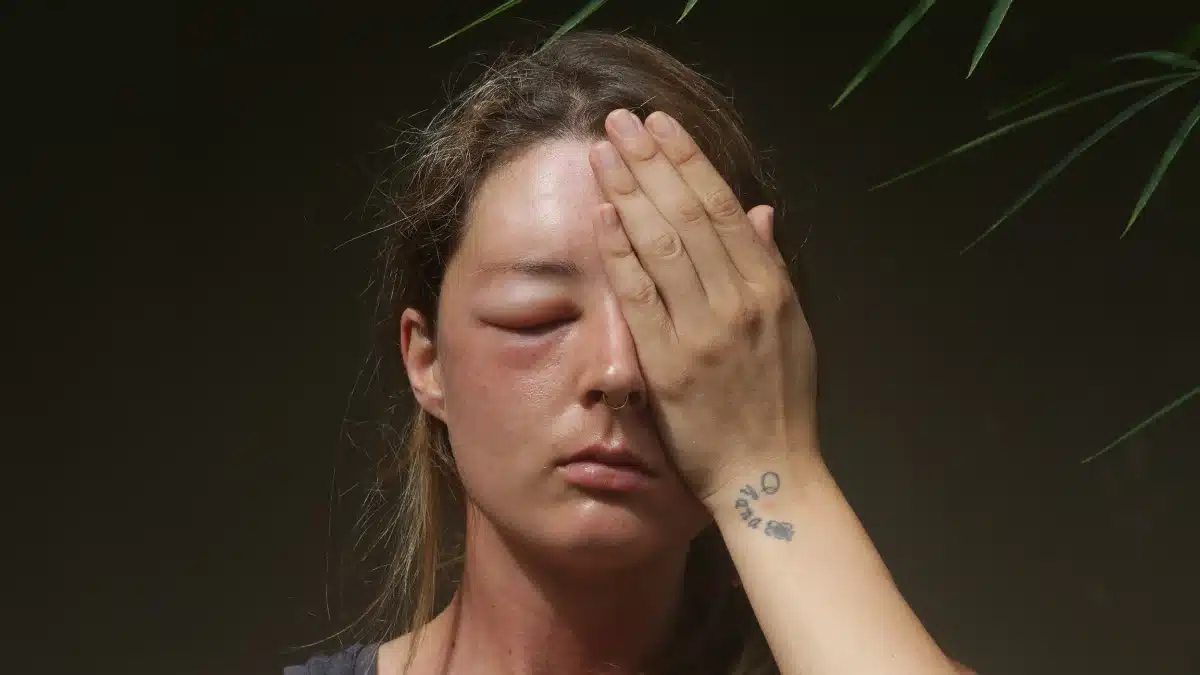 swollen eye remedies
