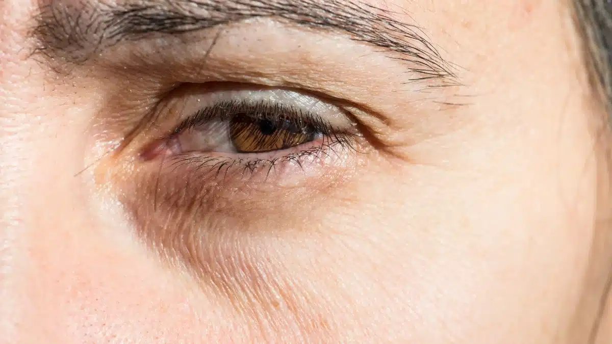 what causes bags under eyes