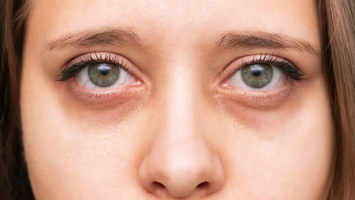 what causes dark circles under eyes