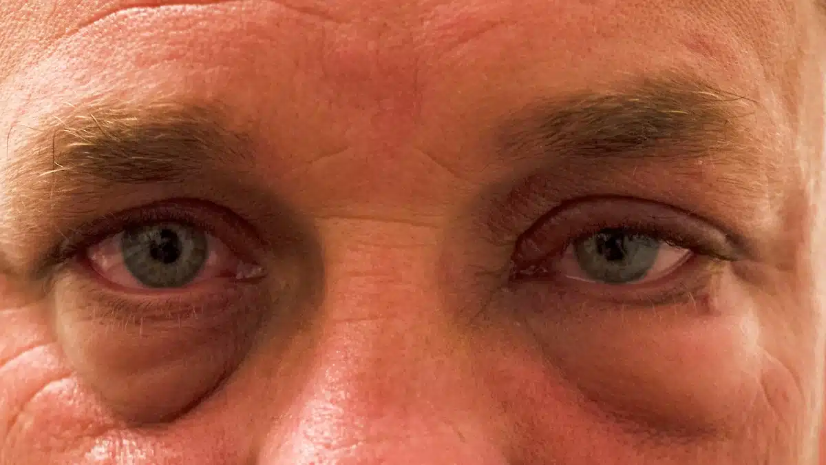 why is my eye swollen