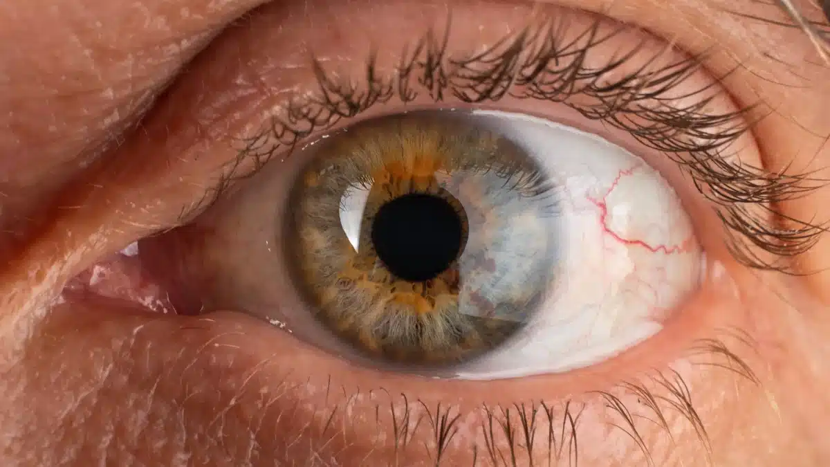 corneal ulcer treatment