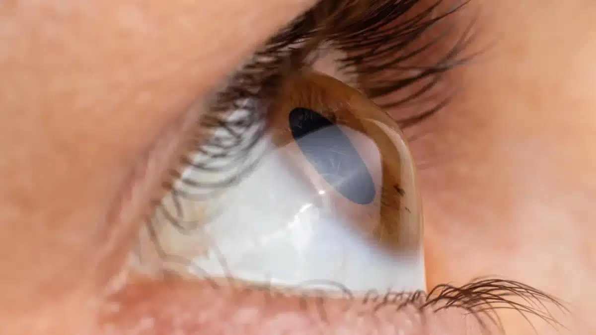 keratoconus