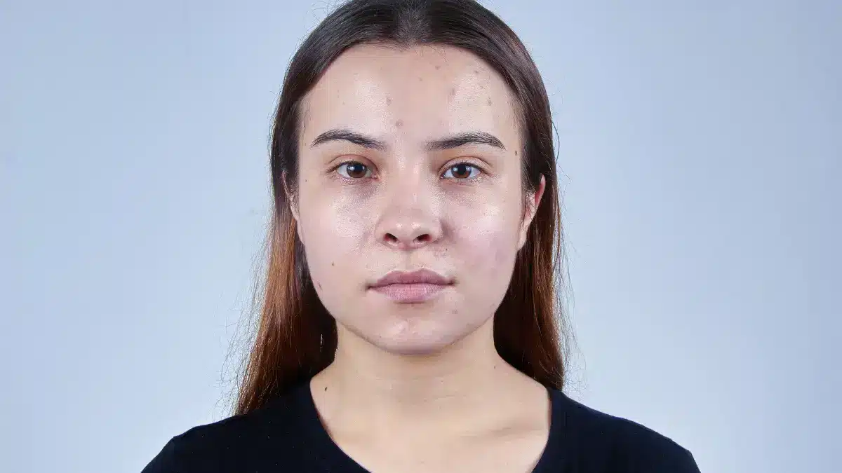 pcos acne