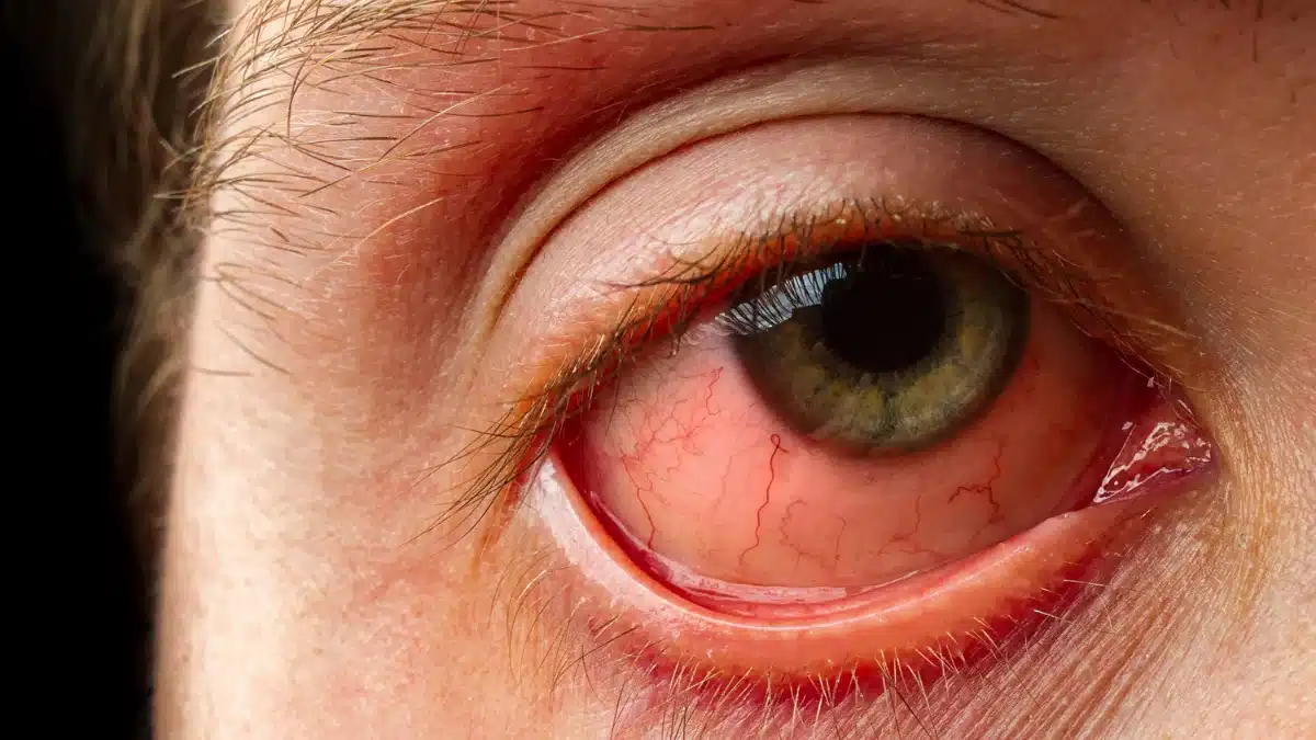 causes of corneal ulcer