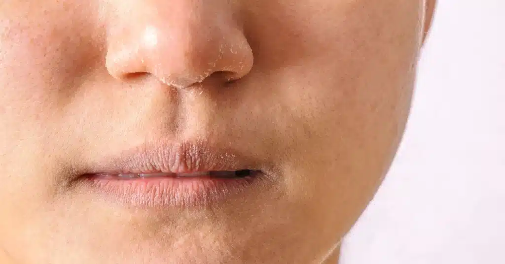 dry skin
