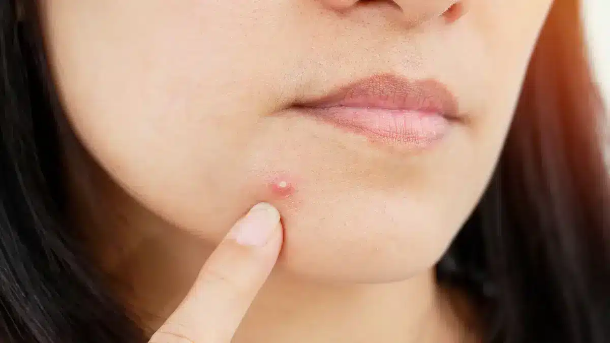 menopause-acne
